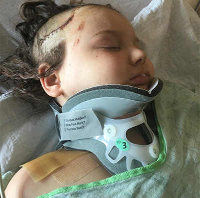 Child in green hospital gown with neck brace and a scar on her head from brain surgery